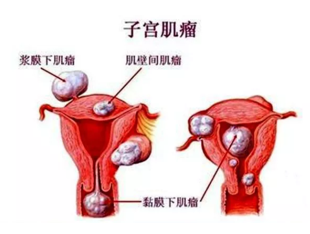 天津津南子宫肌瘤会不会癌变_子宫肌瘤是留还是切