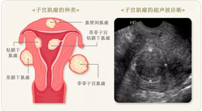 天津津南敖汉旗你知道子宫肌瘤是怎么引起的？
