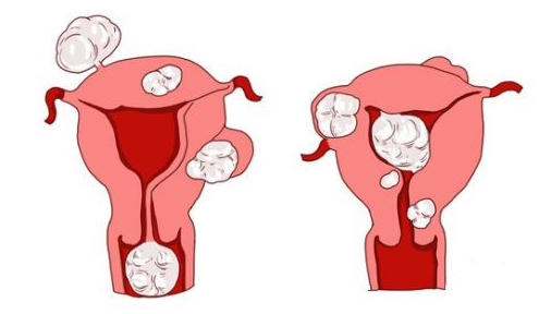 天津津南元宝山区早期子宫肌瘤如何自查？