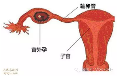 天津津南女性宫外孕用啥子方法治疗更可靠?