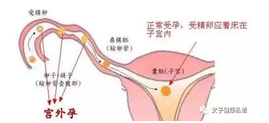 天津津南敖汉旗引起宫外孕的因素有哪些