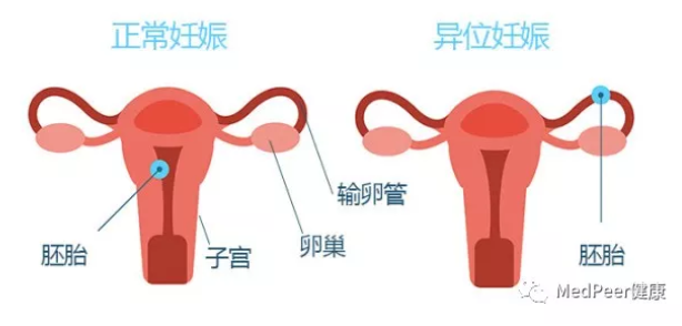 天津津南林西县容易发生宫外孕的女性有哪些